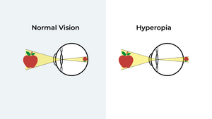 What Is Hyperopia? (Long Sightedness)