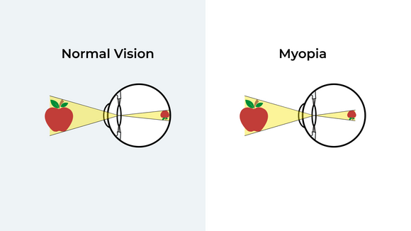What Is Near Sighted Myopia?